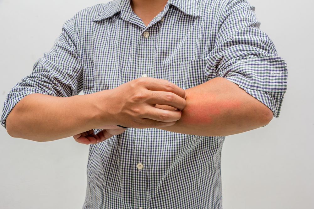 皮膚アレルギーを治療するための薬と治療