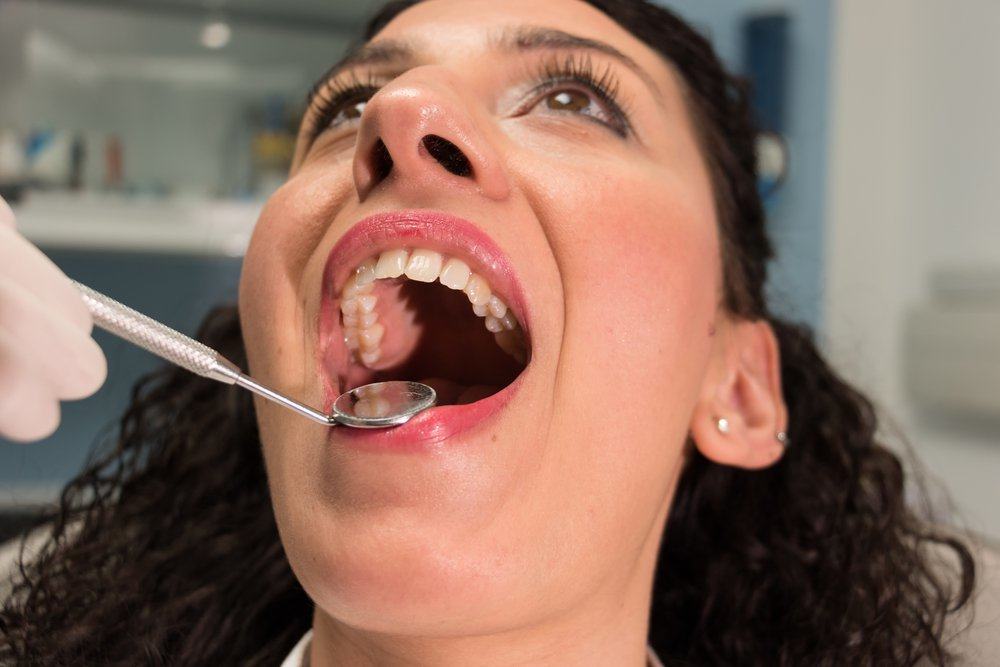 5 fatti sui denti del giudizio che devi sapere