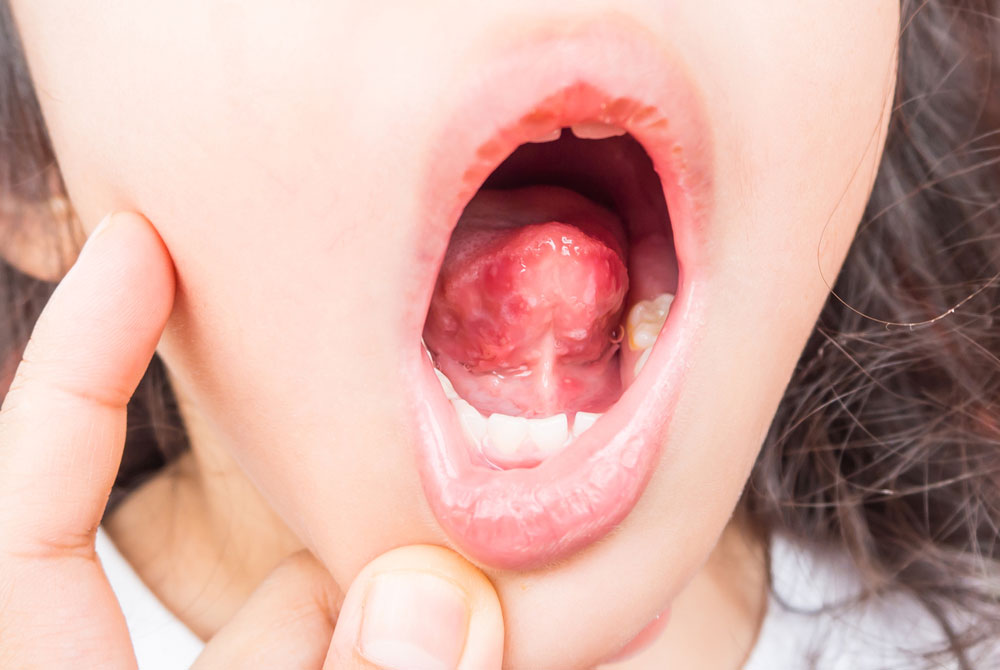 Fai attenzione quando appare un nodulo sulla lingua! Queste varie condizioni causano