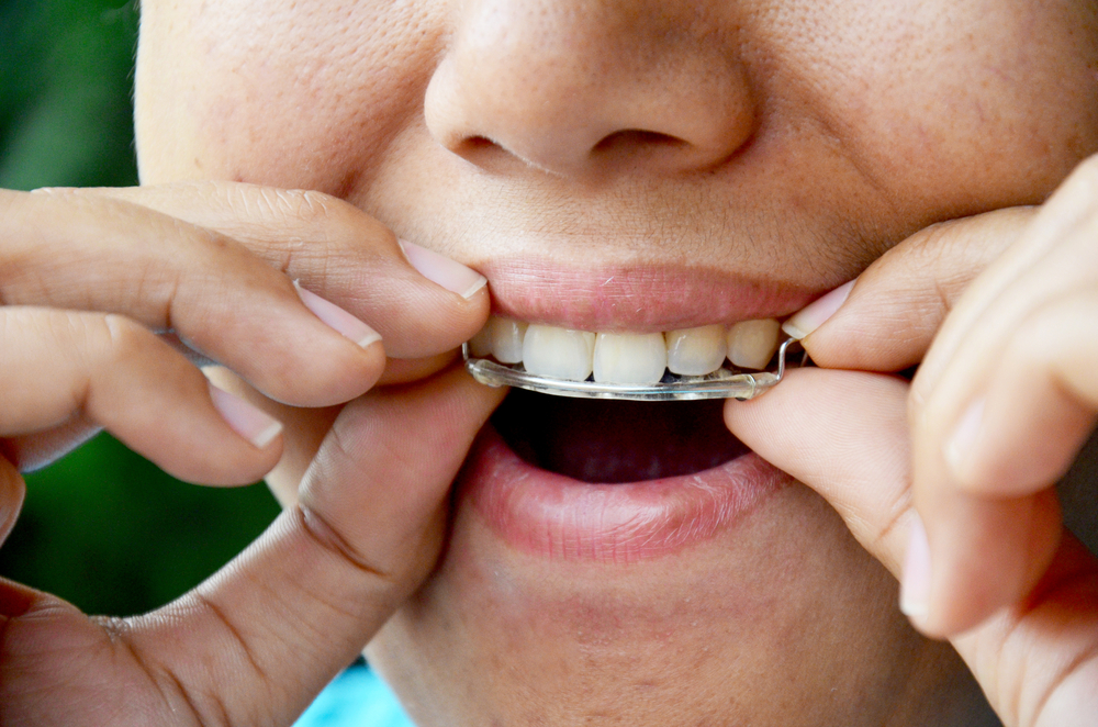 بعد إزالة المشابك هل من الضروري استخدام مثبت الأسنان؟