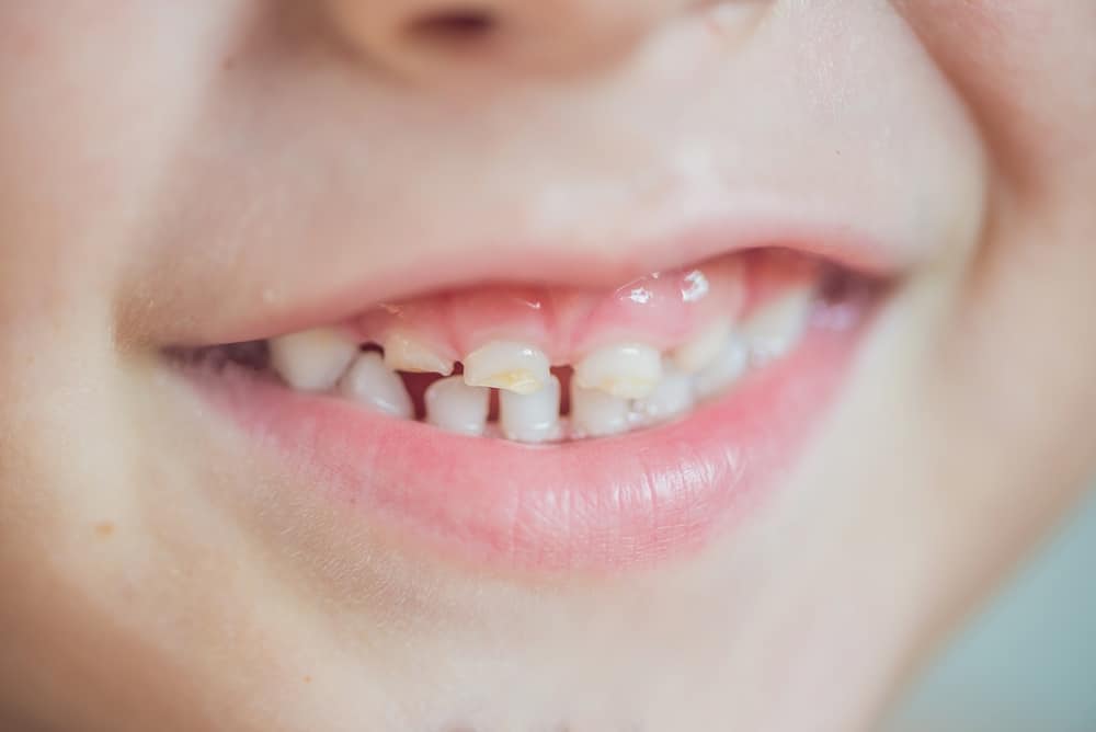 虫歯、歯石、虫歯の違いを知っていますか？