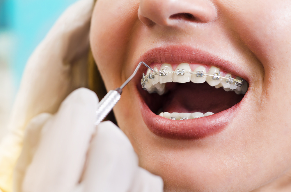 قبل تركيب تقويم الأسنان ، اقرأ أولاً هذه الحقائق الخمس المهمة