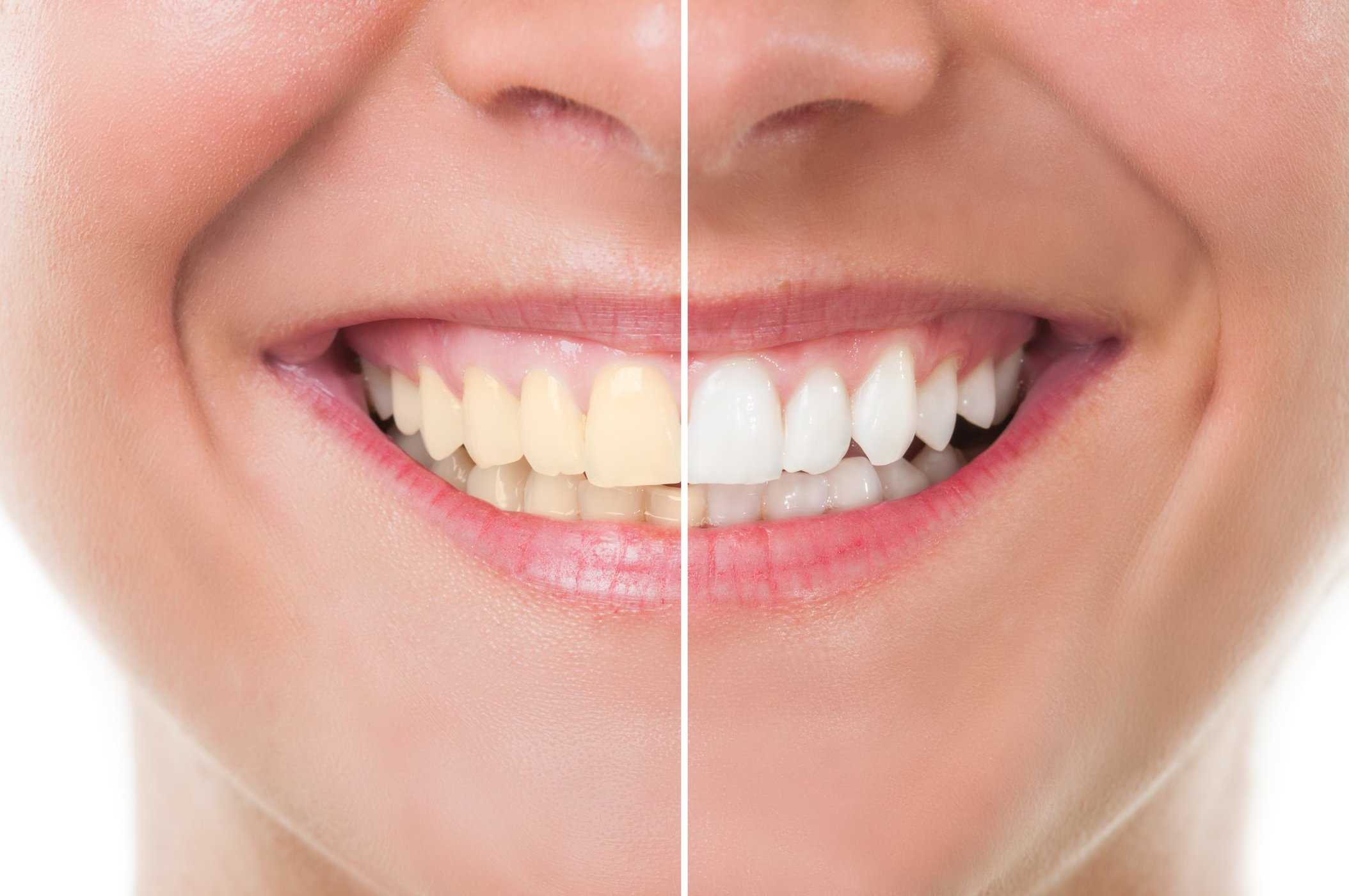 Ефекти от избелването върху избелването на зъбите, има ли за какво да внимавате?