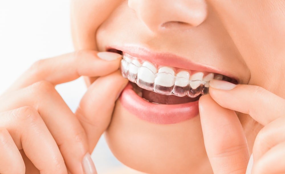 Invisalignを使用して歯を矯正する前に知っておくべき7つのこと