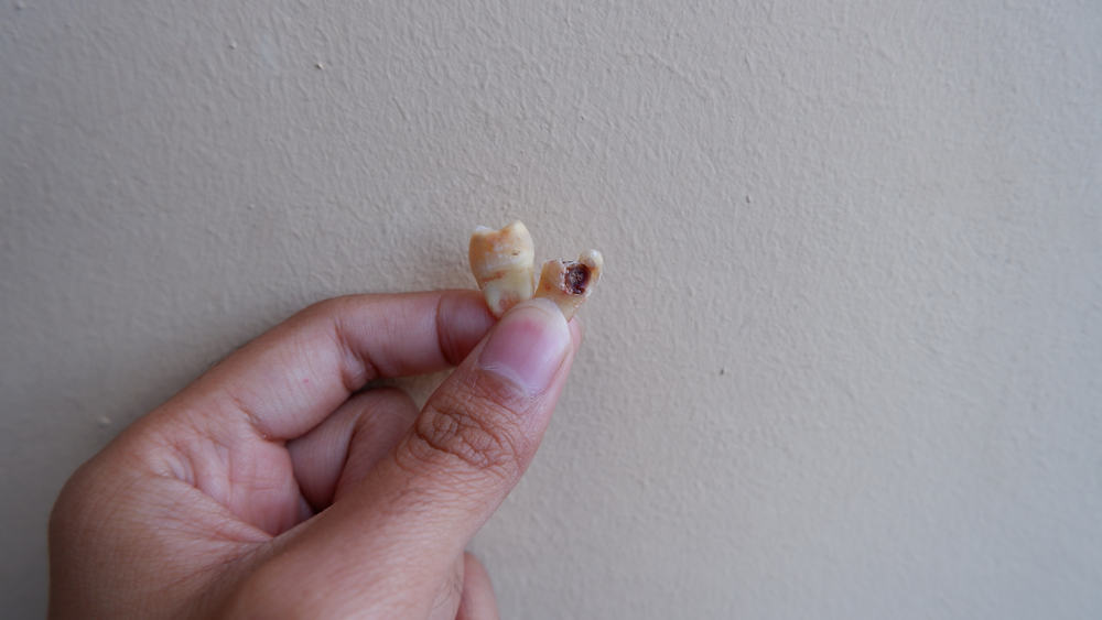 Punca Gigi Mati yang Perlu Anda Perhatikan, Bolehkah Ia Diubati?