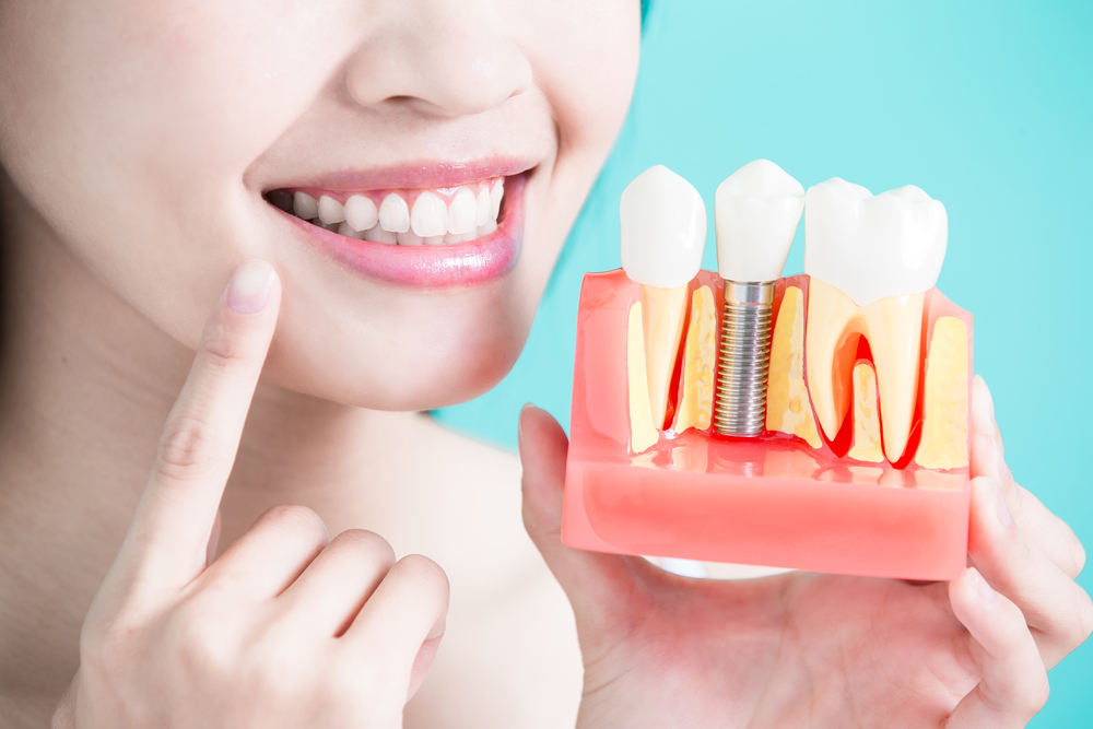 Запознаване с процедурата за зъбни импланти, какви са предимствата?
