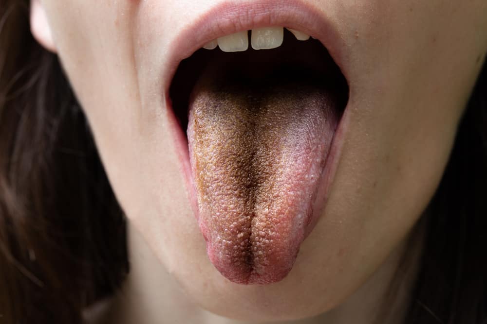 5 причини за появата на черен език, започвайки от пушене до състояние на суха уста