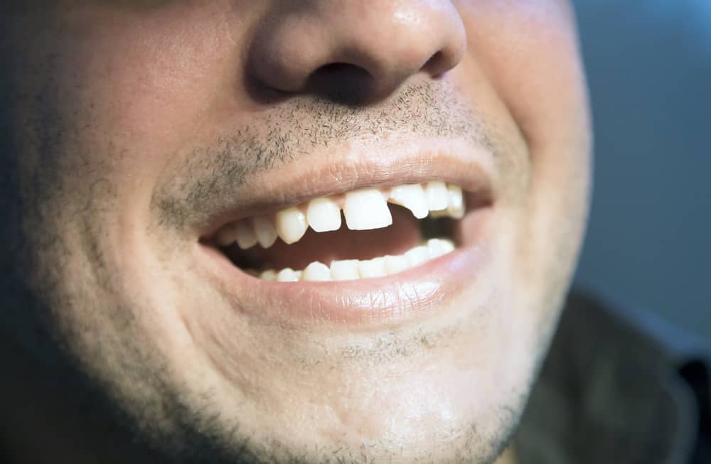 壊れた歯、それを引き起こす原因とそれを修正する方法は？