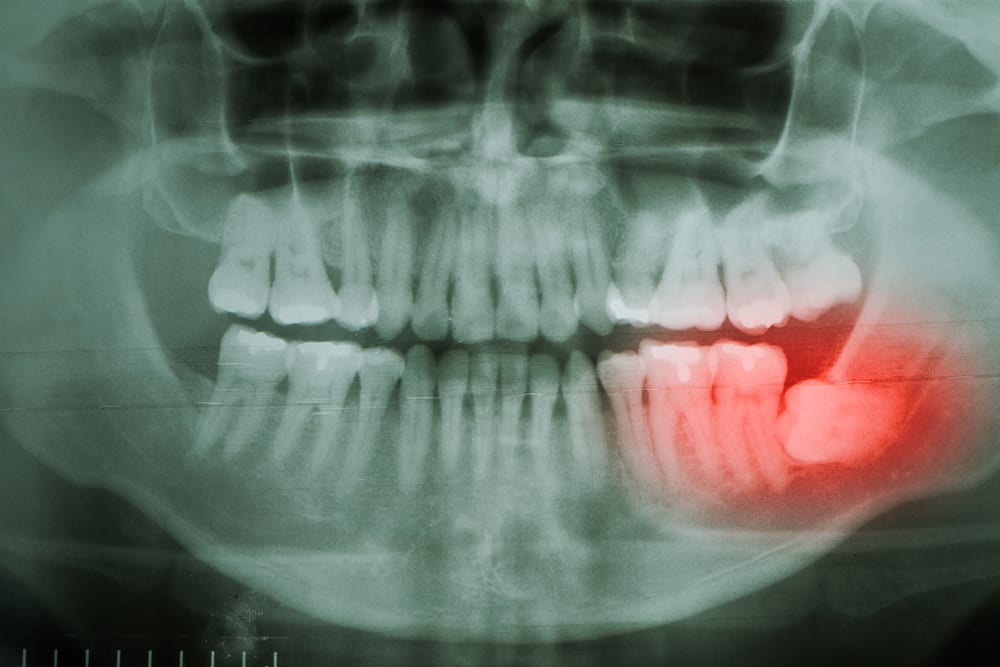 Mengapa Kebijaksanaan Gigi Boleh Menyakitkan?
