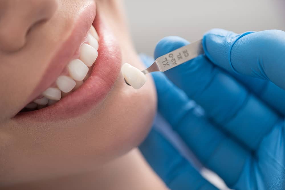Sebelum Memasang Dental Crown, Ketahui dahulu Kesan-kesan Sampingan Yang Berbagai