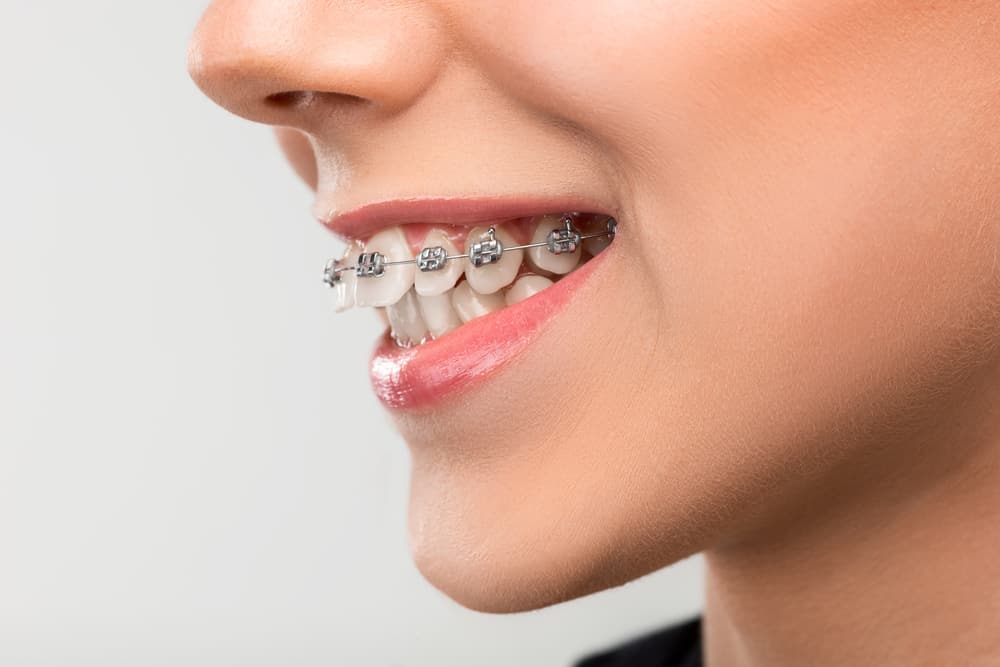 أسباب اعوجاج الأسنان وخيارات علاجها
