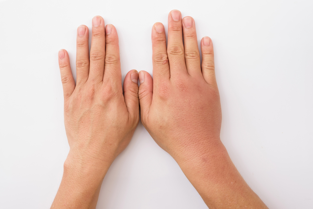 5 начина за преодоляване на подути пръсти според причината