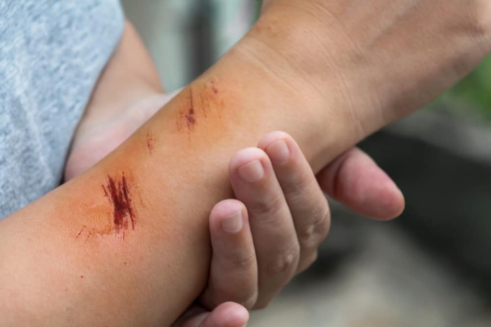 Vari tipi di ferite sulla pelle e loro trattamento