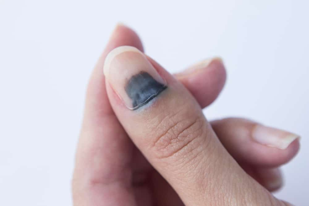 爪の暗い線は黒色腫がんの兆候である可能性があります