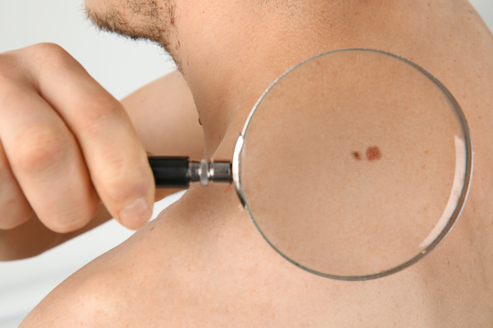 التعرف على الخصائص أو الأعراض المختلفة لسرطان الجلد