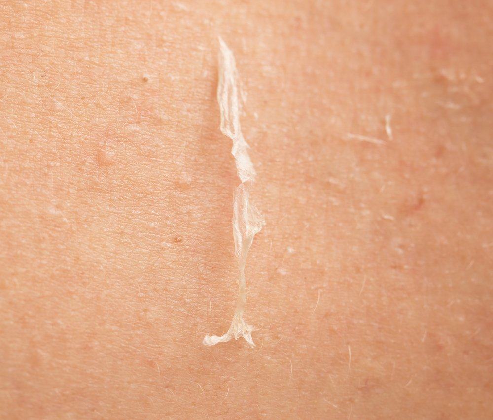 うろこ状の皮膚の剥離の原因とそれらを克服するためのヒント
