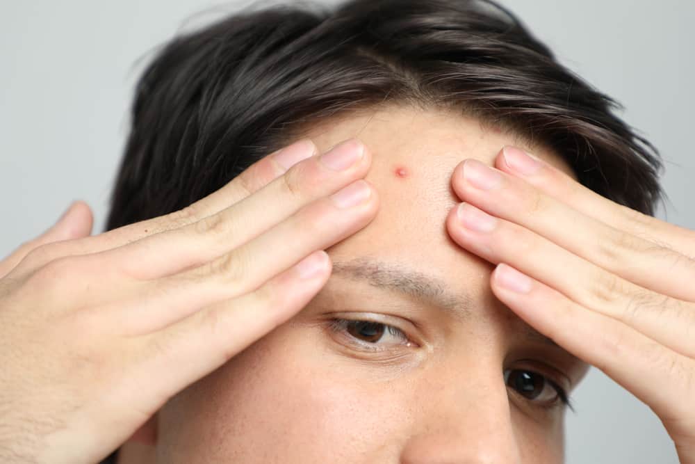 Riconoscere le cause dell'acne sulla fronte e modi efficaci per superarla