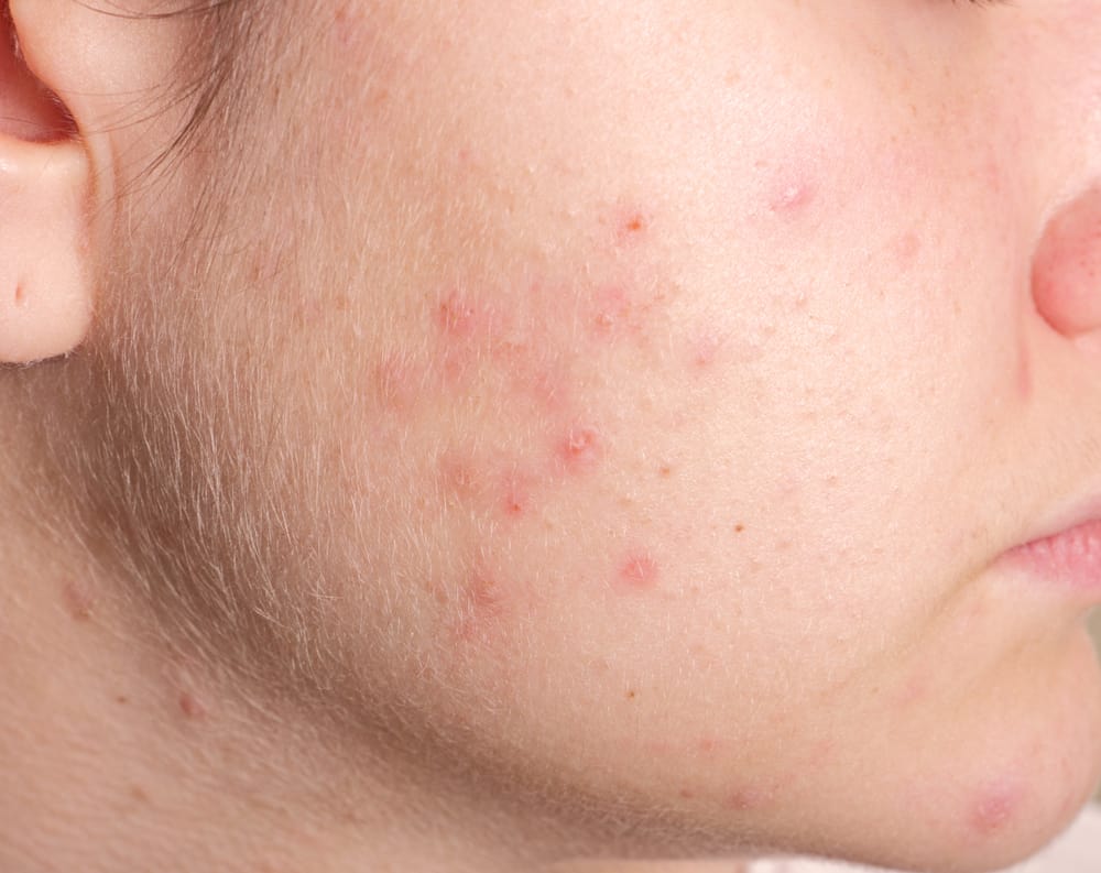 Pelle secca dell'acne? Questa è la causa e come trattarla