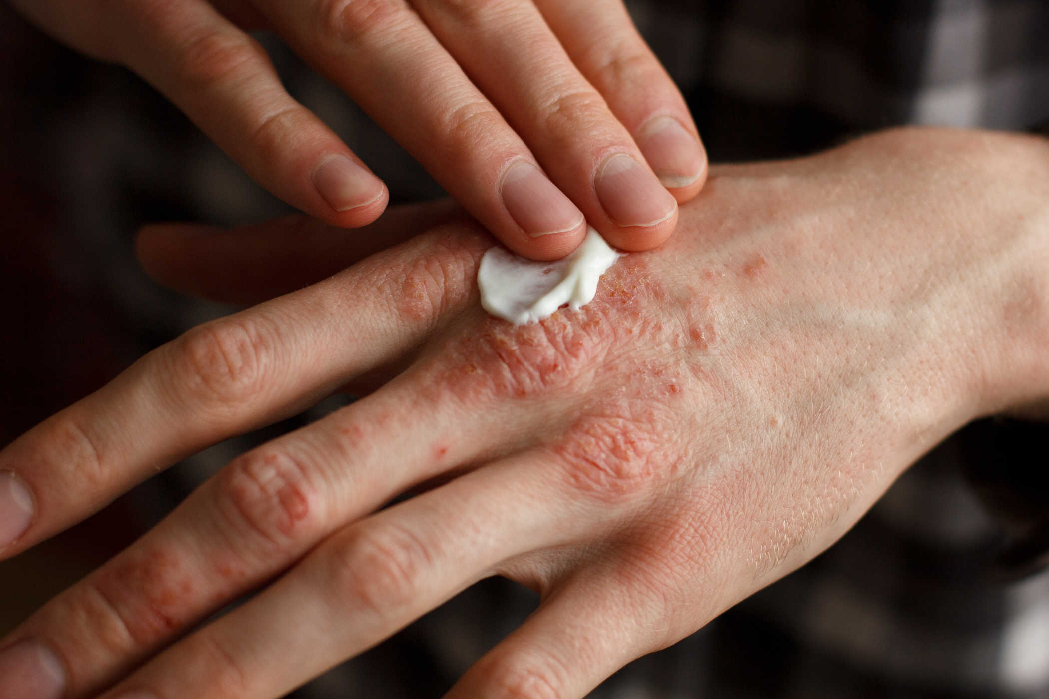 Varie medicine tradizionali efficaci per superare l'eczema