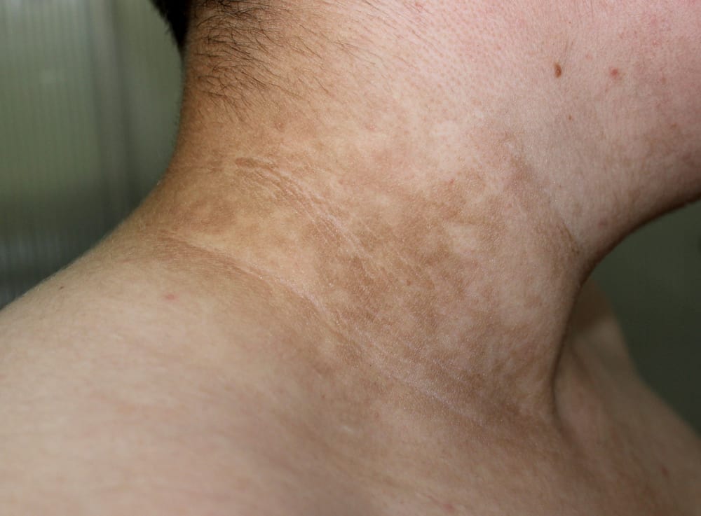Хиперпигментация на кожата