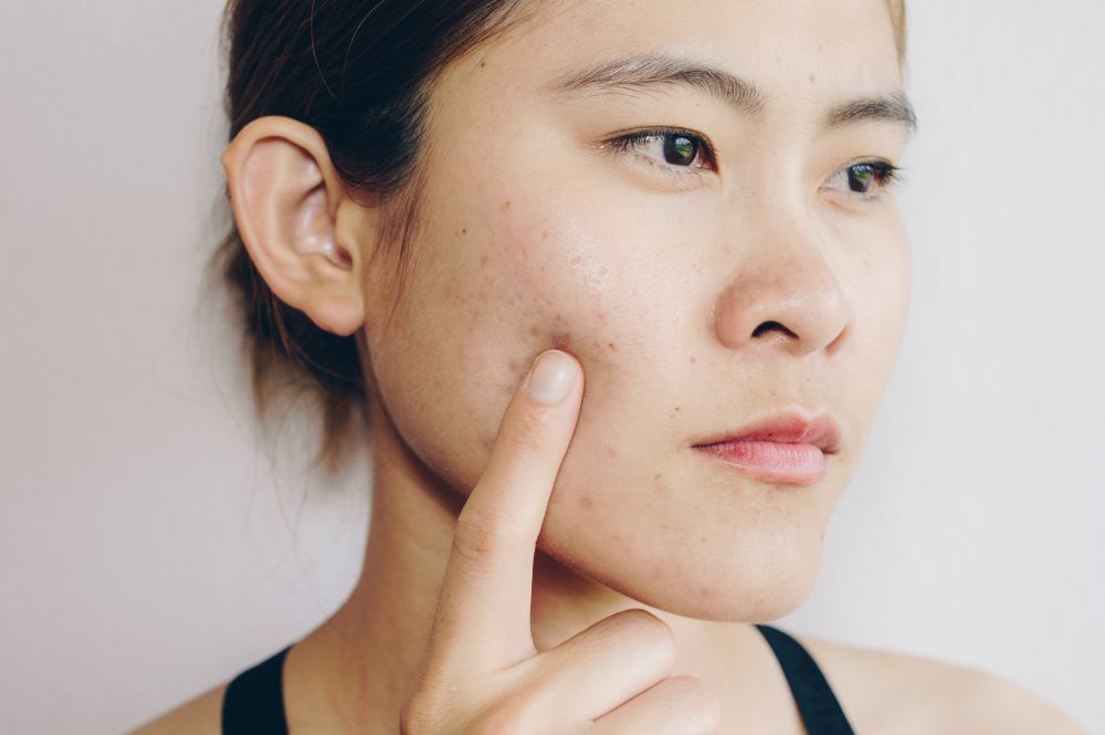 Che cos'è lo spurgo e in che modo è diverso dall'acne da sfogo?