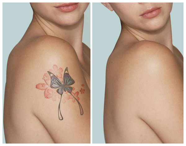 3 -те най -сигурни начина за премахване на татуировки