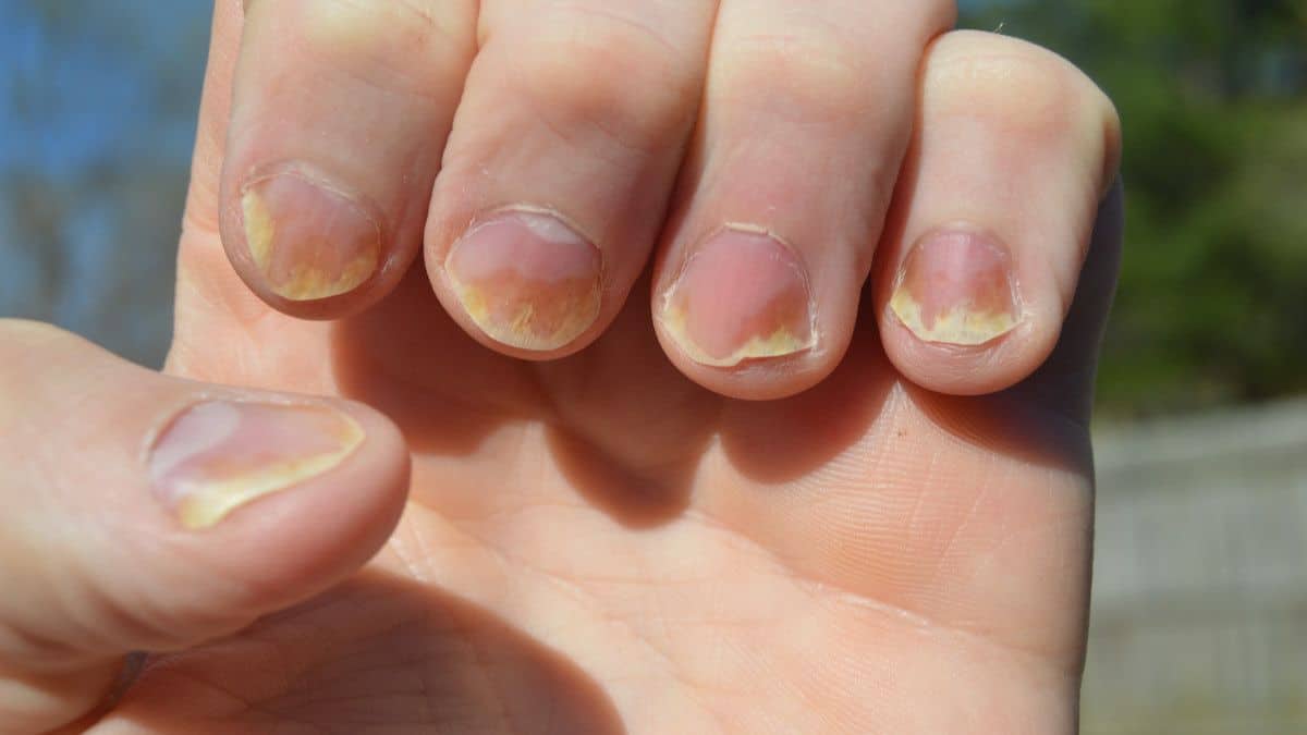 原因、症状、および爪の乾癬を克服する方法