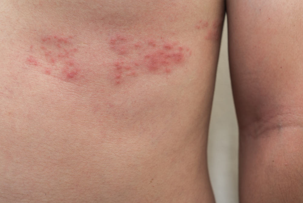 水痘にかかったことがある場合は、将来帯状疱疹になるリスクがあります