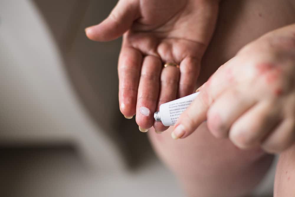 Cara memilih ubat untuk kulit gatal akibat jangkitan kulit kulat