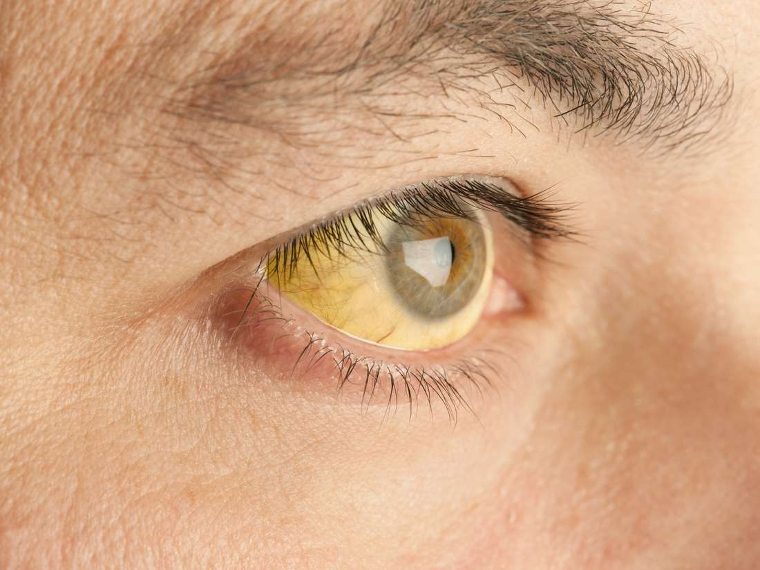 Причини за жълти очи (жълтеница) и как да се преодолее