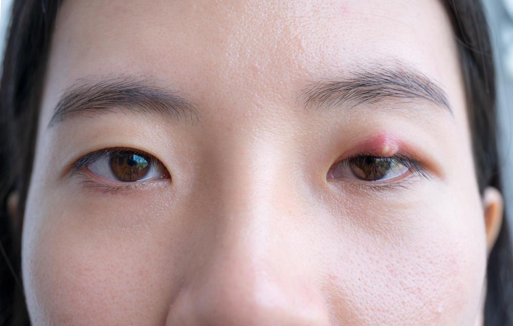6 Cara Menghilangkan Lebam pada Kelopak Mata (Kalazion)