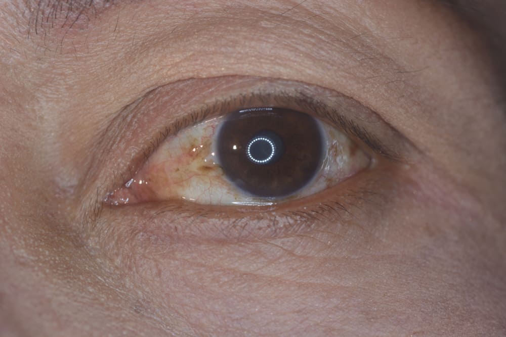 瞼裂斑を知る、黄色い斑点が目に現れるとき