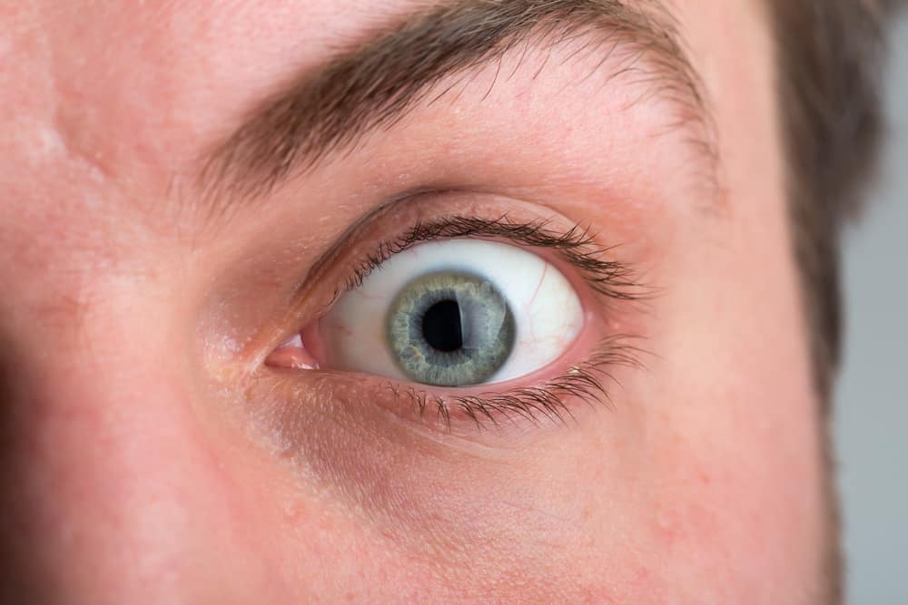 Proptosis ، حالة تبرز فيها العين بشكل غير طبيعي