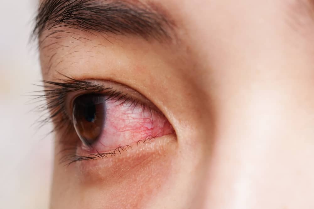 طرق مختلفة للتغلب على العيون الحمراء موصى بها طبيا