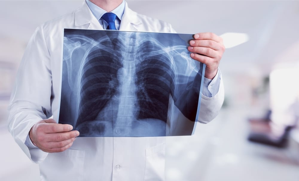 Mengenal Pleuropneumonia, Radang paru-paru dan Pleura