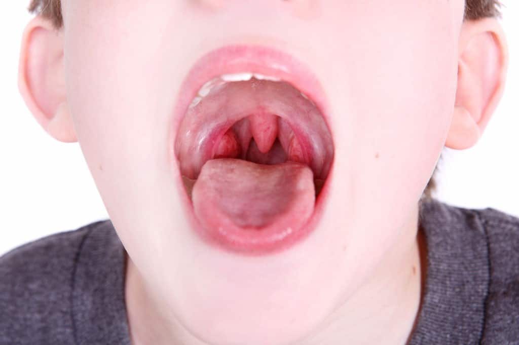 7 cose che possono causare tonsille gonfie