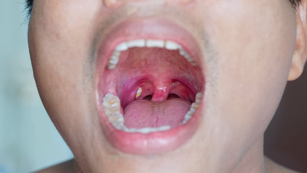 I calcoli tonsillari causano l'alitosi, conosci le cause e il trattamento