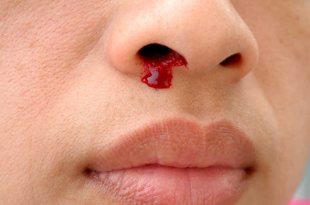 Varie cause di sangue dal naso da lieve a grave
