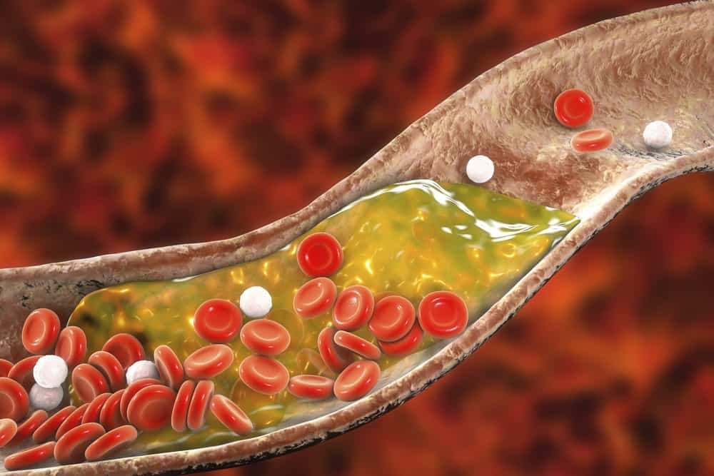 Ketahui Trombosis, Gangguan Pembekuan Darah Yang Boleh Membawa Maut