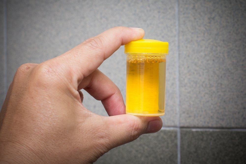 Terapi Urin dengan Meminum Urin, Benarkah Berkesan?