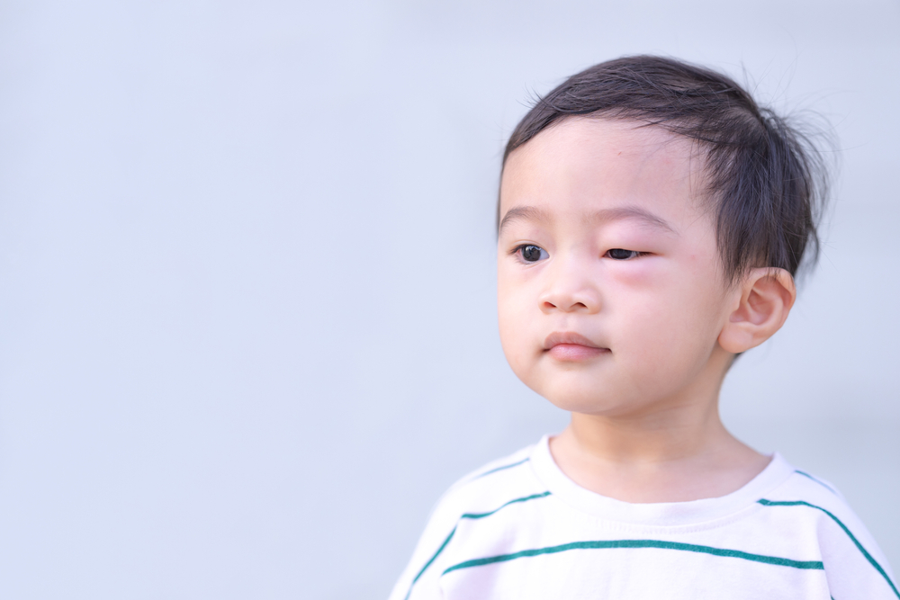 Rivedere le varie cause degli occhi gonfi nei bambini e come curarli