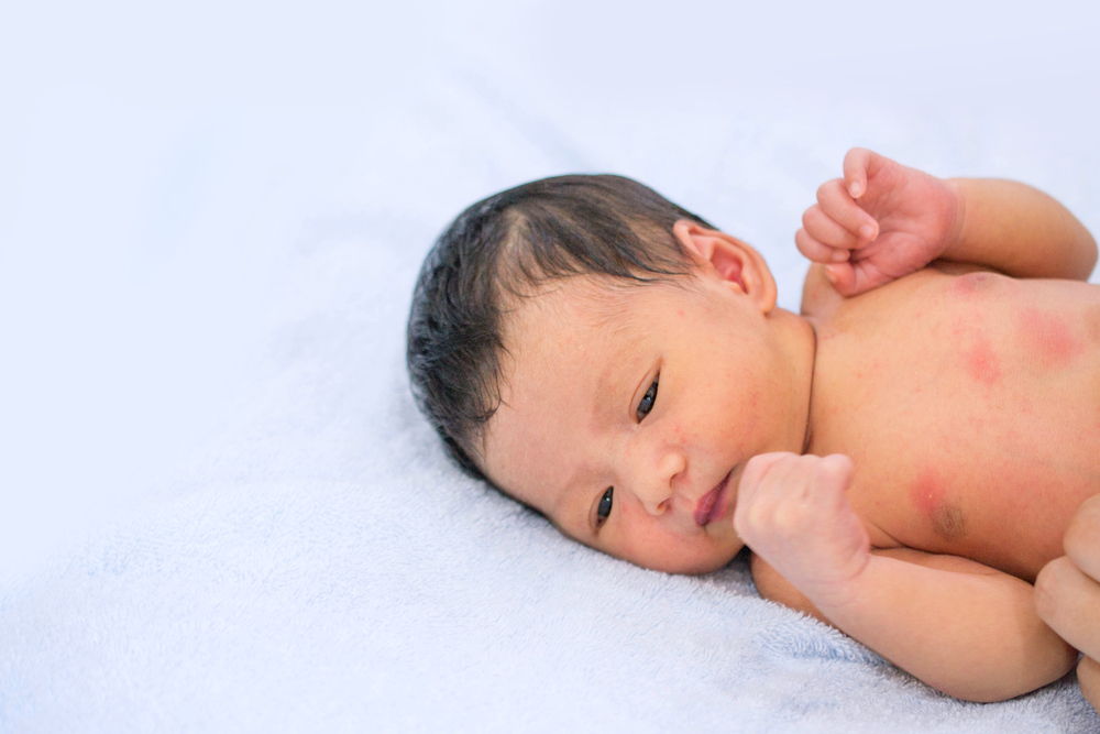 Червени удари при бебета: причини и как да ги преодолеем