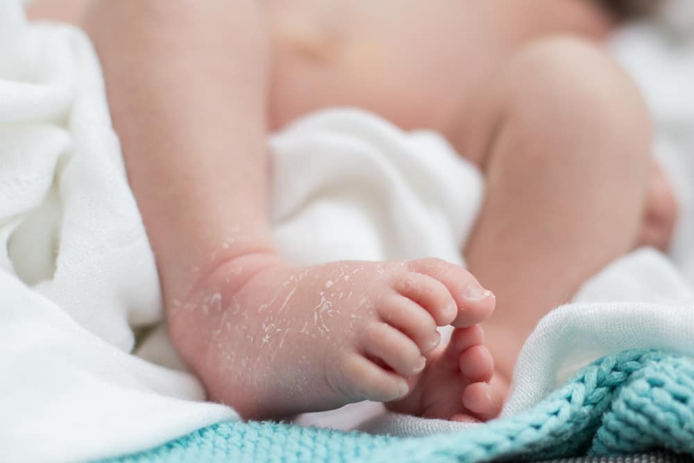 Бебешката кожа е суха, за да се обели? Това е причината, как да я предотвратим и преодолеем
