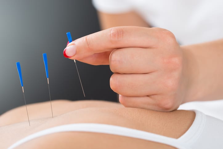 Vari benefici e rischi dell'agopuntura
