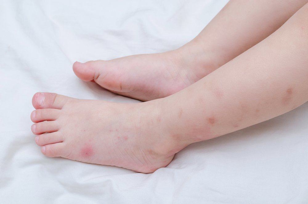 Пазете се от симптомите на хеморагична треска на денга (DHF) при деца