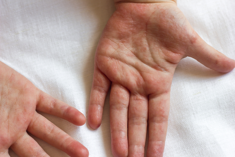 Причини и лечение на херпетичен уайтлоу, херпесна инфекция на пръстите