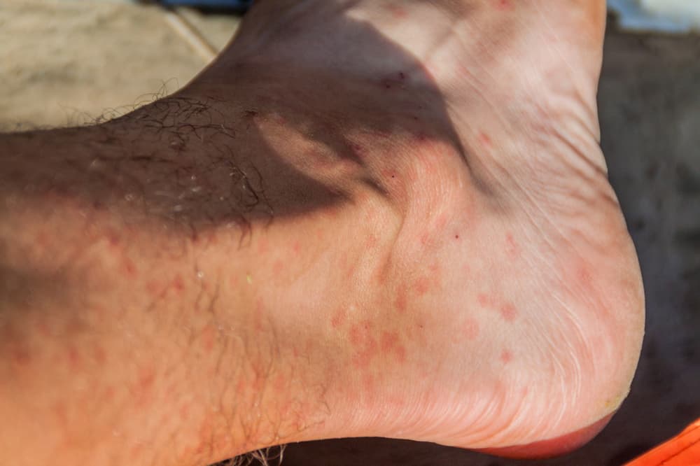 Лайшманиоза, смъртоносна инфекция, причинена от ухапвания от мухи