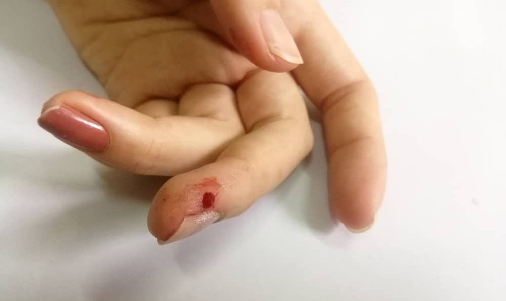 Bıçak yaraları: İlk yardım ve nasıl tedavi edilir